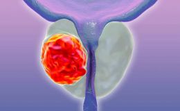 前列腺癌类器官